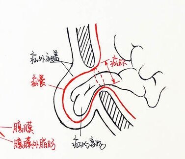 腹股溝疝 - 好大夫在線