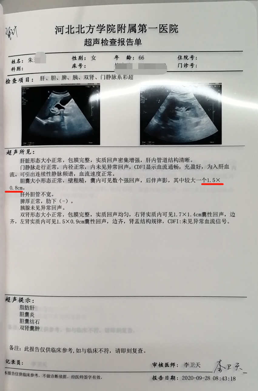 肝内胆管结石超声报告图片