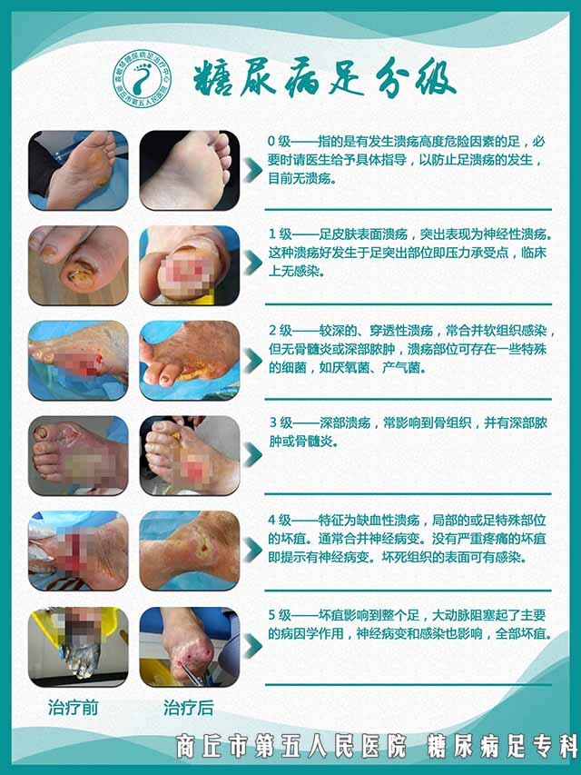 糖尿病并发症足病不一定有伤口,从轻到重有哪些症状?