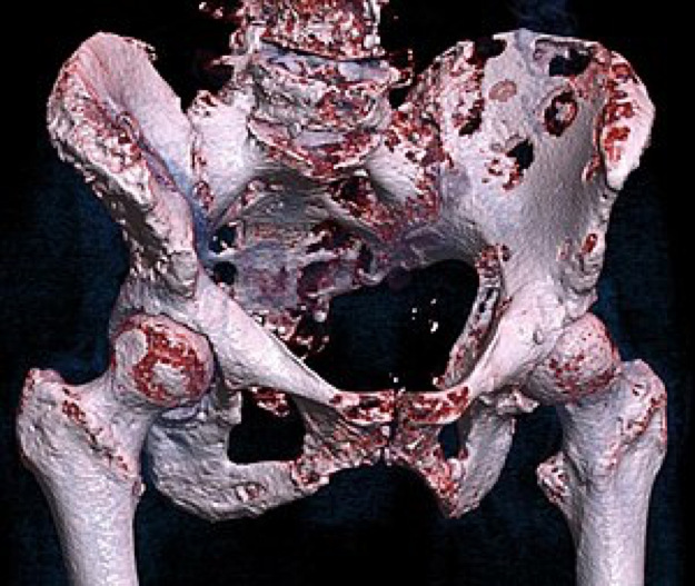 骨癌病人的骨头图片图片