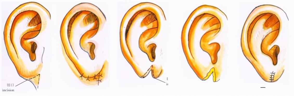 烧伤多因1,耳垂粘连耳垂畸形种类和修复方法