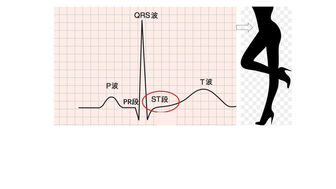 各种st段压低第三个波是t波,也非常重要.