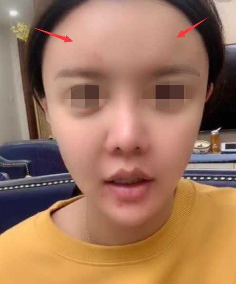 填充面部手术视频_面部填充手术_填充面部手术要多少钱