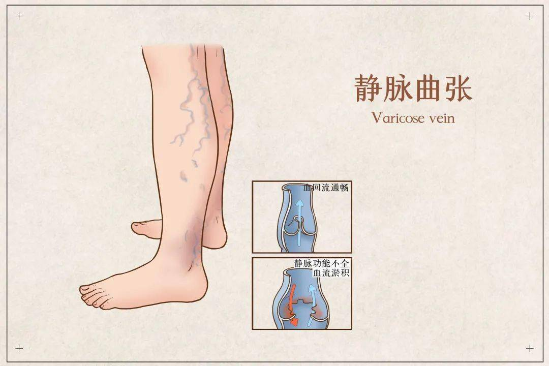 如何對付蚯蚓腿青筋明顯靜脈曲張請到血管外科來看看