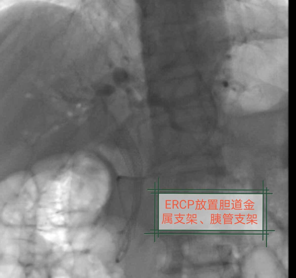 胆道金属支架_edit_372289743174963.jpg