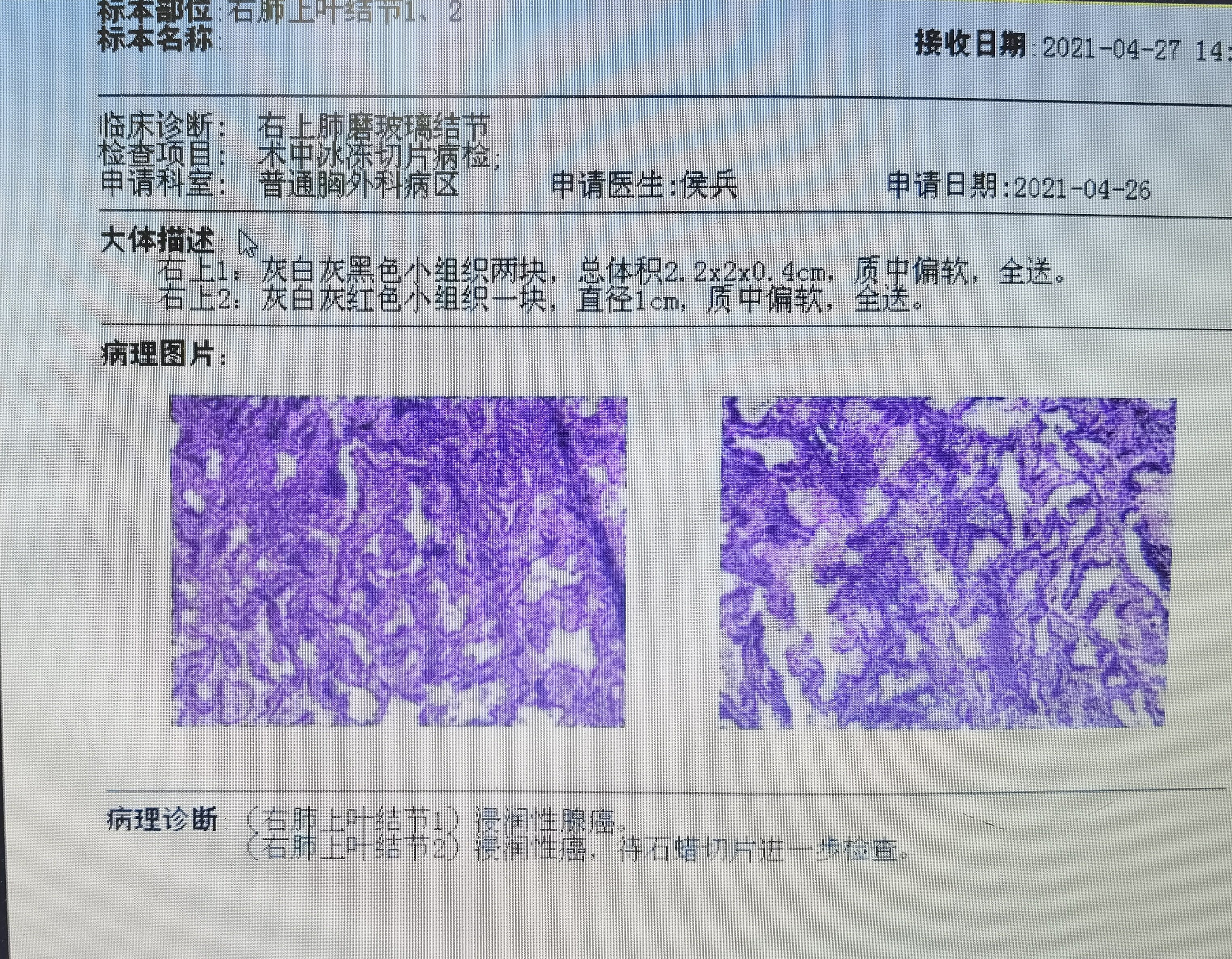 磨玻璃肺结节遭遇实性结节怎么办?