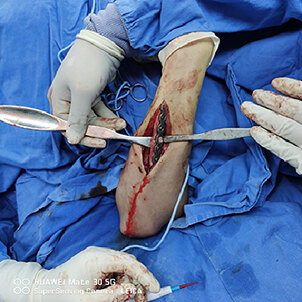 图3:切开行尺骨畸形矫形内固定术,术中透视见尺骨畸形矫正固定满意图4