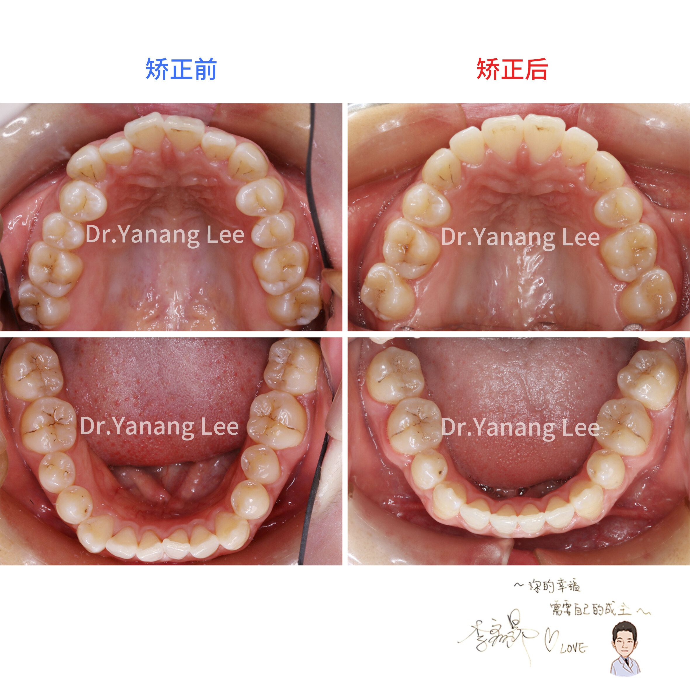 【前牙对刃,侧切牙反颌矫正案例】