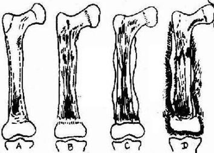 小儿骨髓炎的病因与治疗