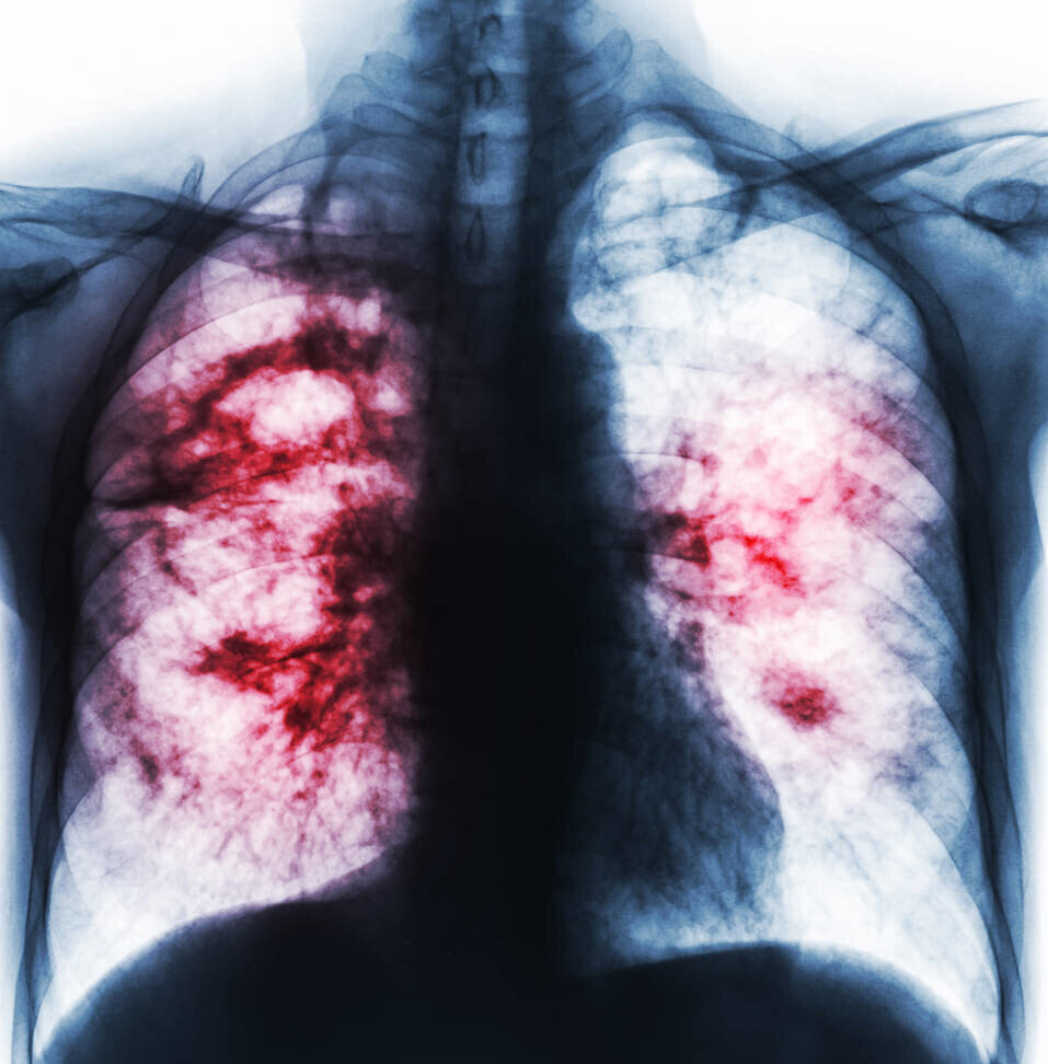 肺癌晚期的肺照片图片