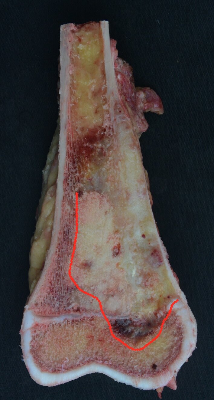 儿童及成人四肢恶性骨肿瘤保肢治疗应当如何选择治疗方式?