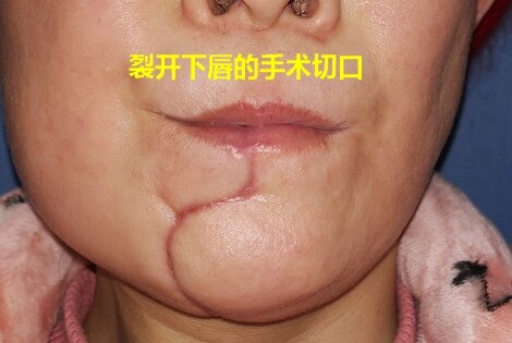 舌癌术后图片