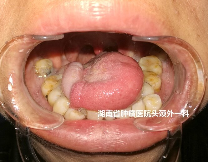 舌癌手术治疗,会毁容吗?(附术前