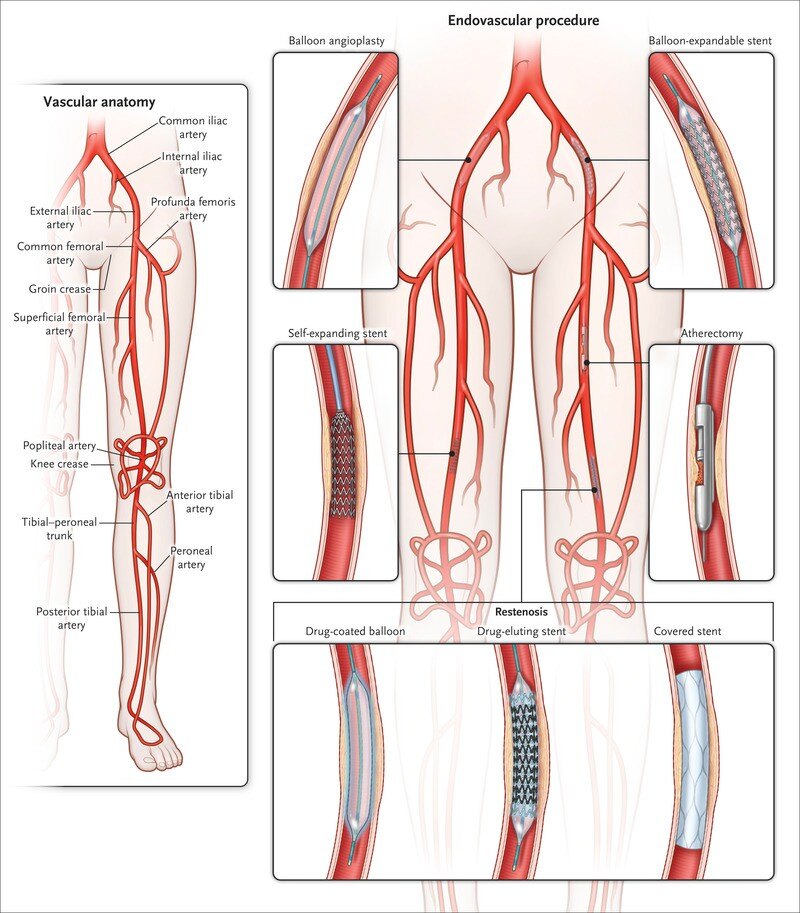 男儿膝下有支架 膝下动脉各类支架和国际临床试验结果大放送