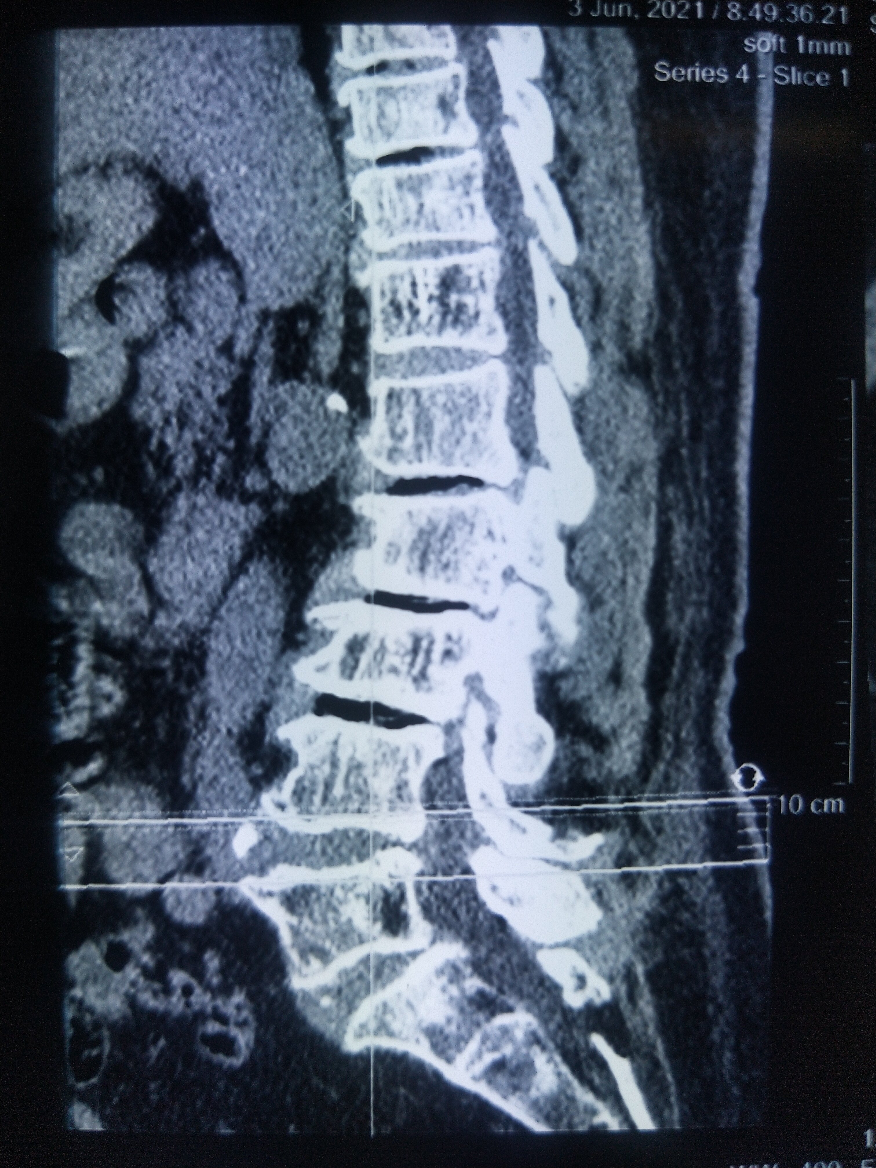 正常脊椎骨ct图片图片