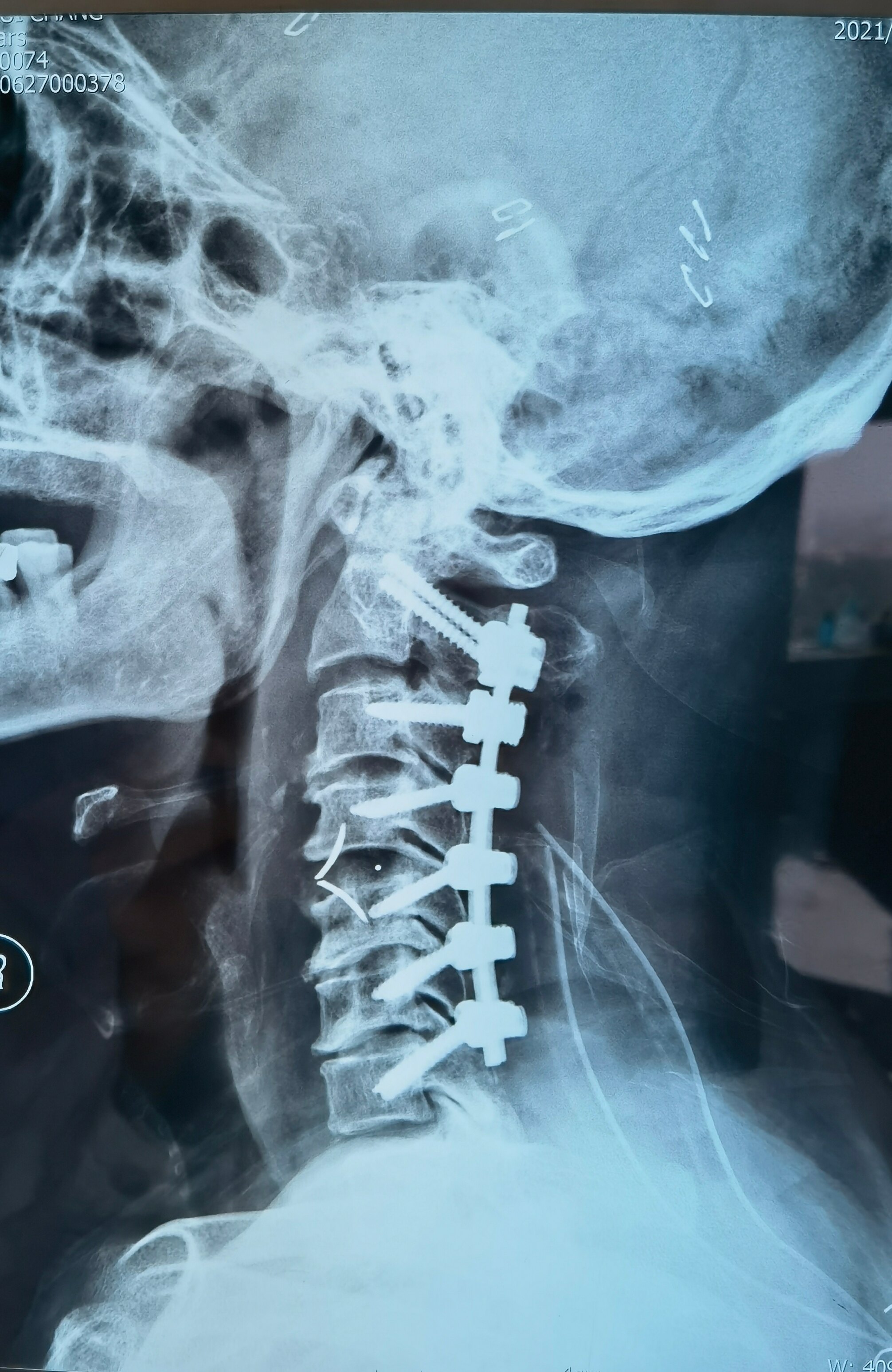应用前后路联合手术成功治疗合并严重颈椎后凸畸形的颈椎病患者