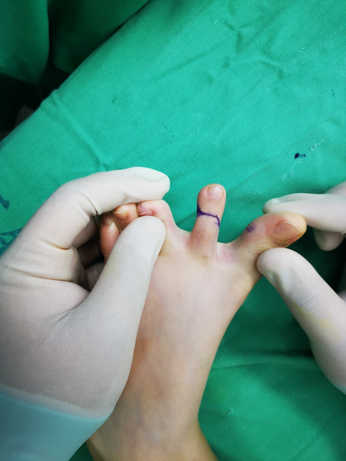 无锡九院小儿骨科完成2021年院内首例儿童第2足趾游离移植再造食指末