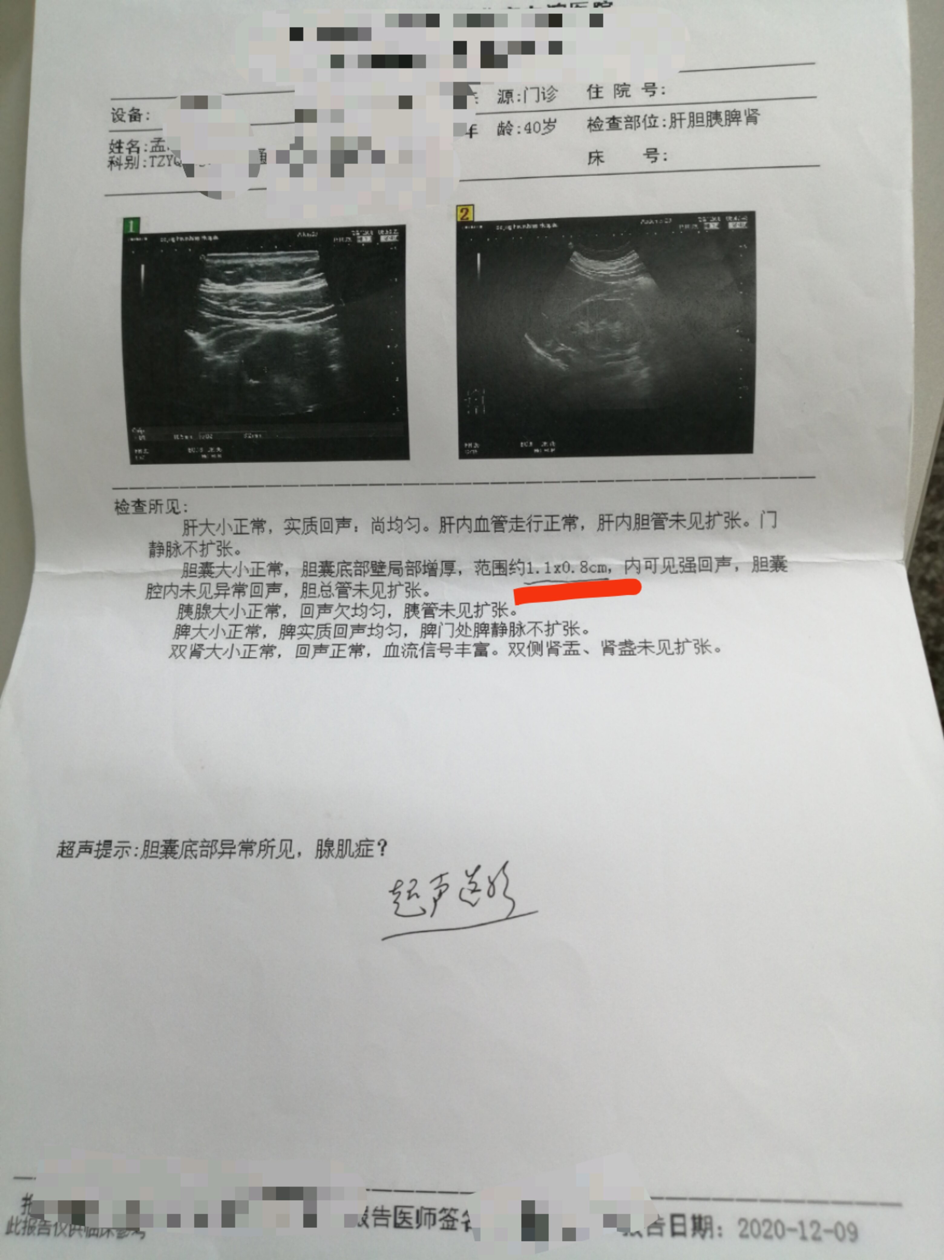 膽囊腺肌症患者中藥治療痊癒病例