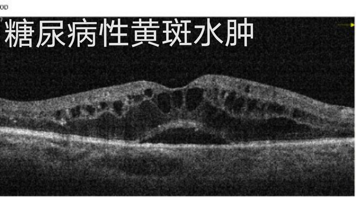 眼底黄斑病变的疾病,此外,常见的还有视网膜静脉阻塞引起的黄斑水肿