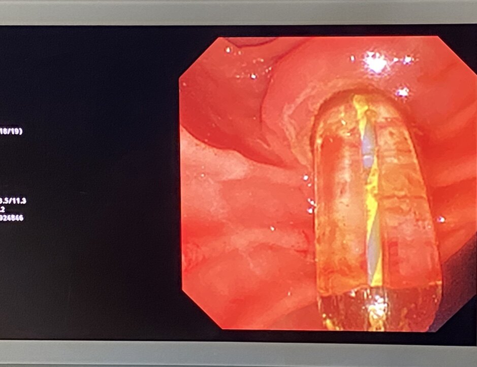 高位截瘫患者的胆管结石并化脓性感染的ercp取石 - 好大夫在线