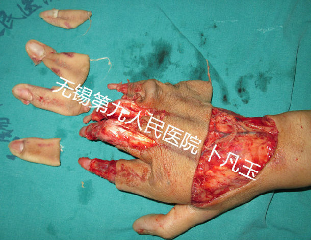 25指脱套手掌皮肤脱套离断伤再植