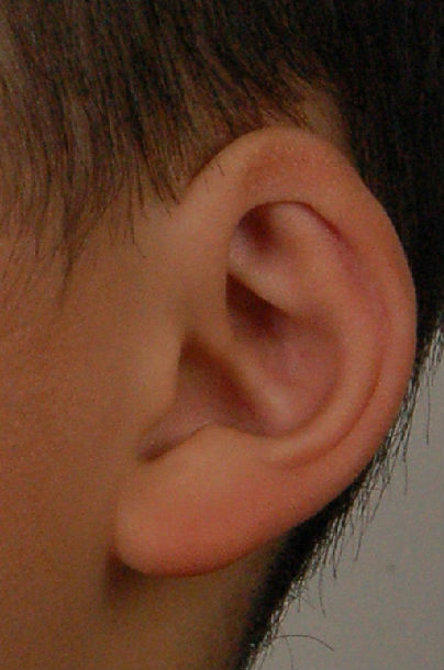 隐耳畸形矫正术前术后照 - 好大夫在线