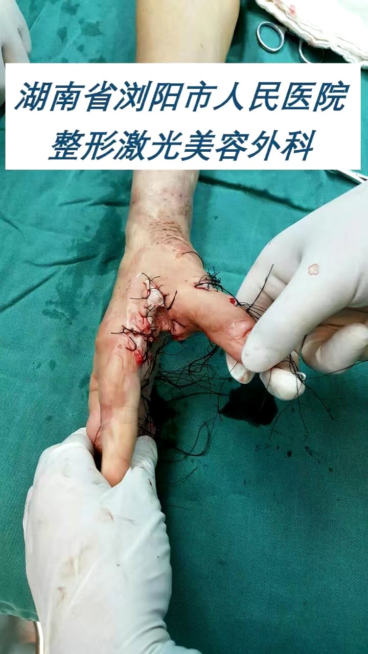 手掌疤痕挛缩畸形整形手术前后对比 