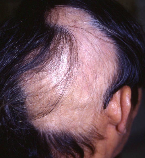 儿童脱发要警惕"拔毛癖"_脱发_治疗方法_缓解方法 - 好大夫在线