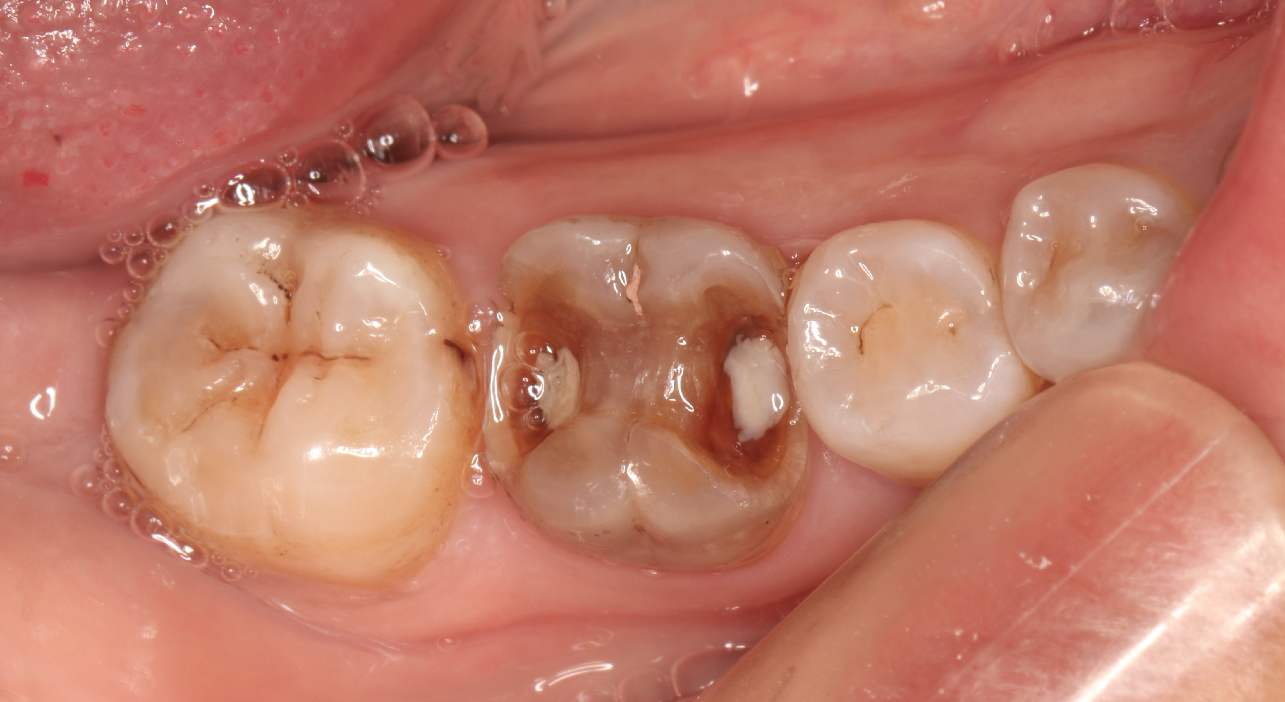 后牙嵌体修复一例 