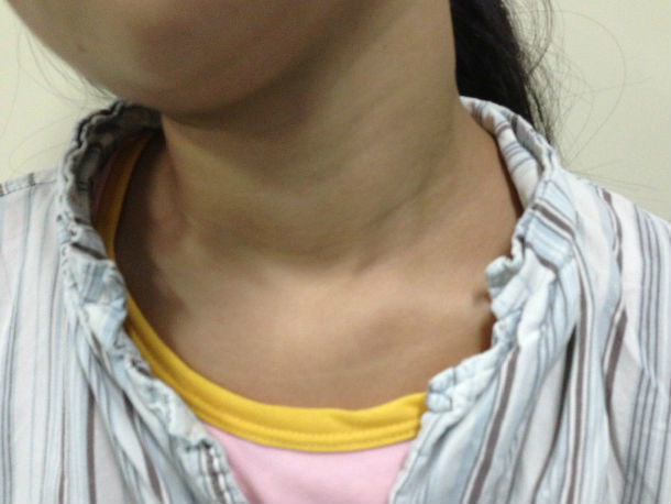 关节镜下微创美容松解先天性肌性斜颈治疗"歪脖子"