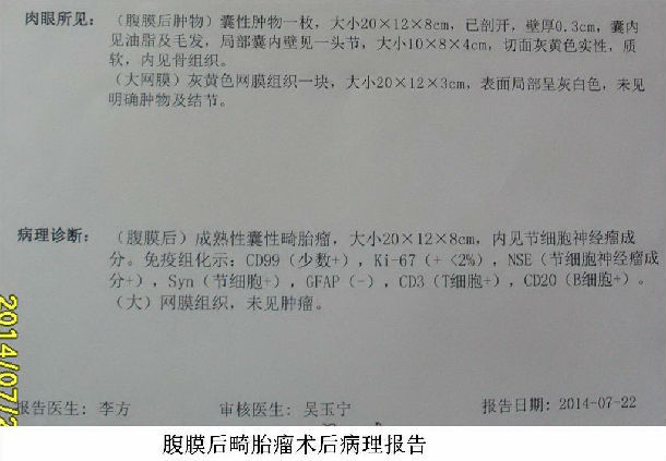 腹膜后肿瘤--成年男性腹膜后畸胎瘤 - 好大夫在线