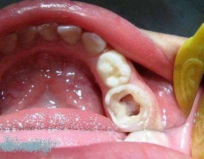 预防预防可导致乳牙牙髓炎和根尖周炎的龋齿,牙外伤等疾患