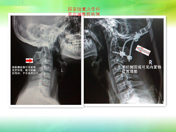 寰樞椎脫位造成的骨性斜頸成功糾正 - 好大夫在線