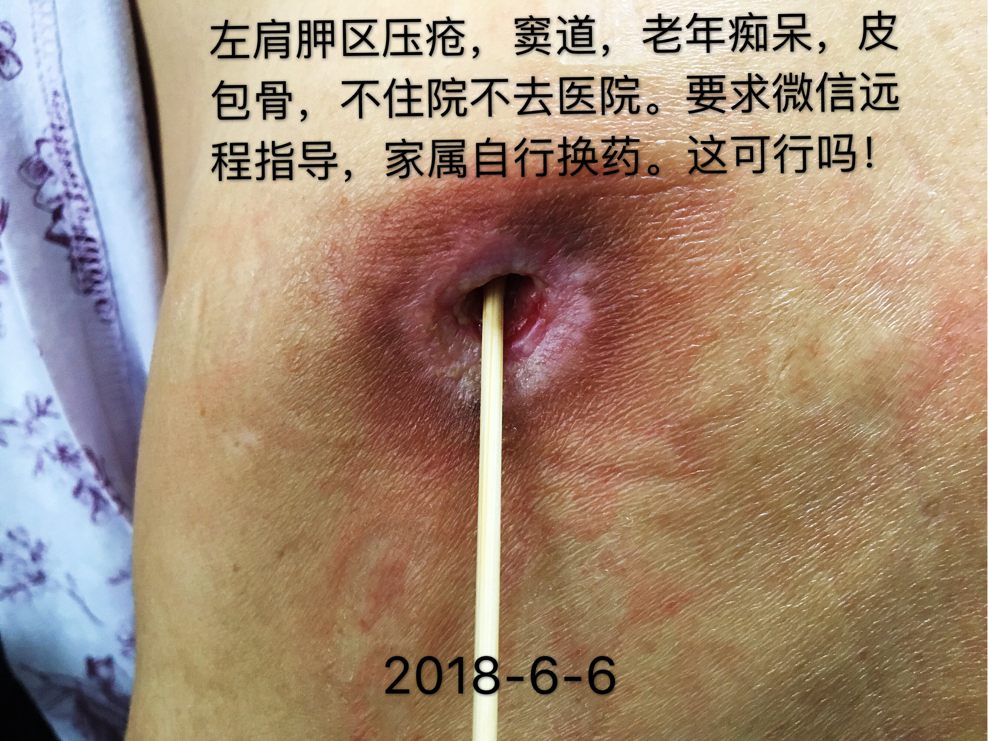 压疮 家庭处理而愈合 压疮 家庭处理而愈合