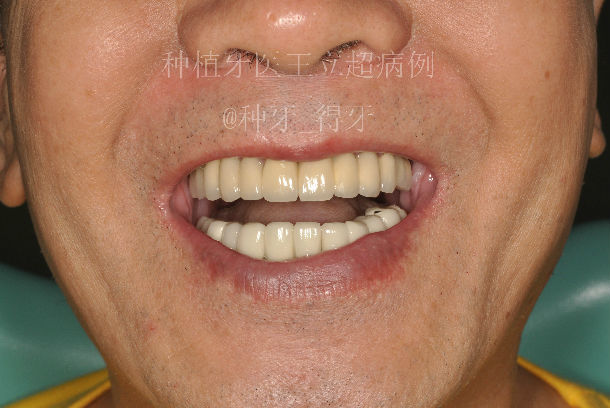 全口半口缺牙可以种牙吗? - 好大夫在线