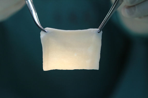 青少年(8岁以上)腹股沟疝生物补片修补手术 - 好大夫在线