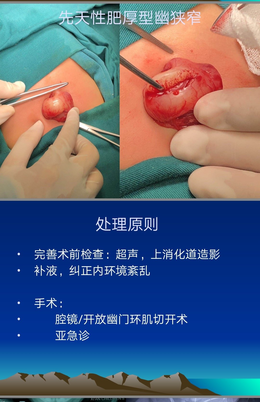 先天性肥厚型幽门狭窄 - 好大夫在线