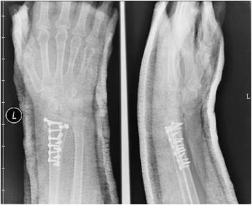 π型鋼板治療橈骨遠端骨折