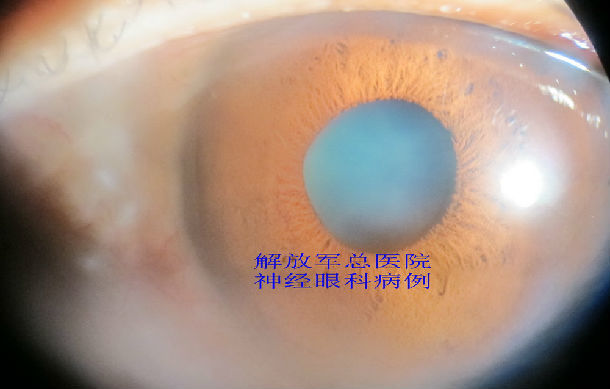 argyll roberston瞳孔,神经梅毒一例
