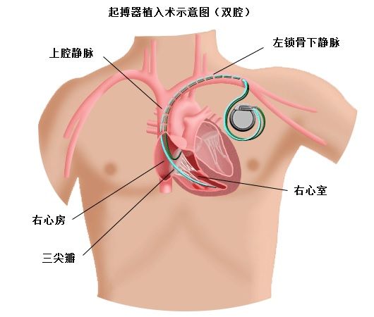 房室传导阻滞的预后