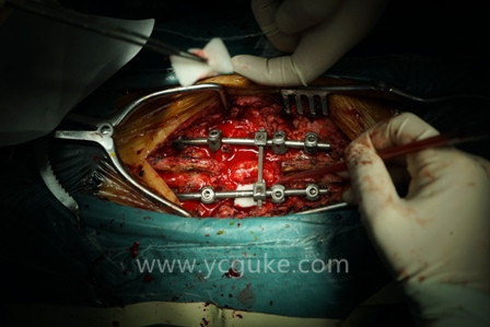 驼背畸形图片手术图片