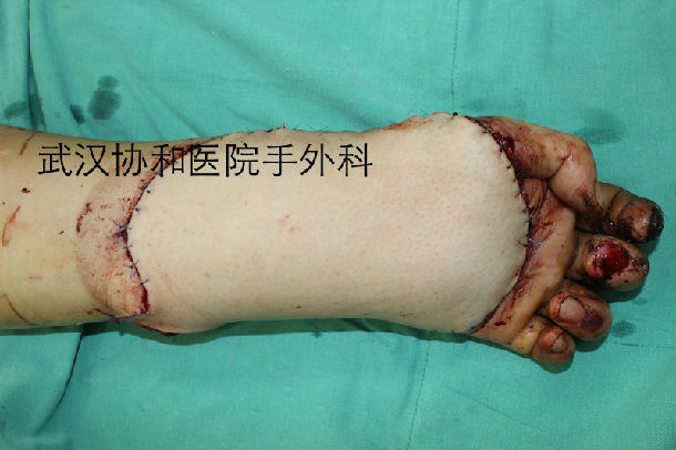 2014年10月20日完成的一例复杂烧伤的皮瓣转移手术 - 好大夫在线