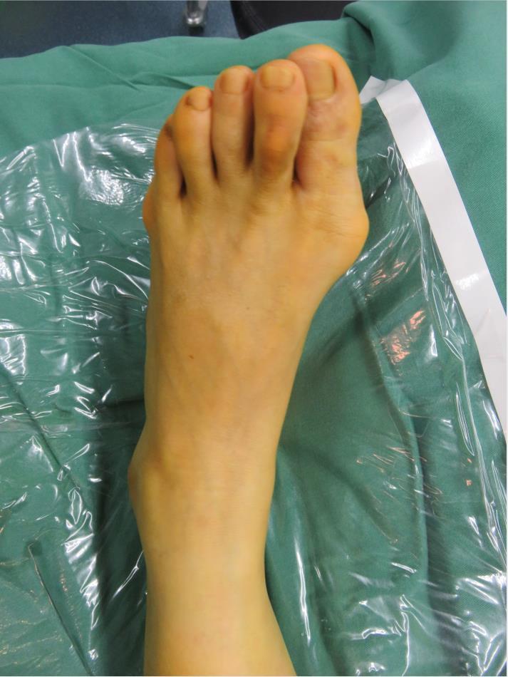 足趾畸形图片