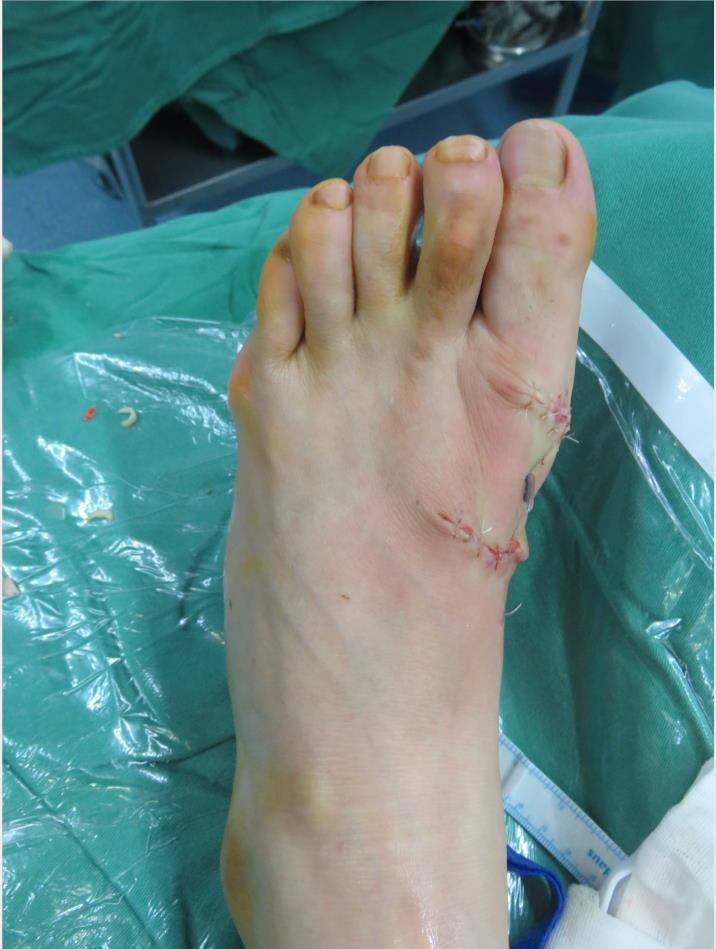 或反复发作时需要手术;畸形明显,出现二趾受压或足趾重叠相压时,需要