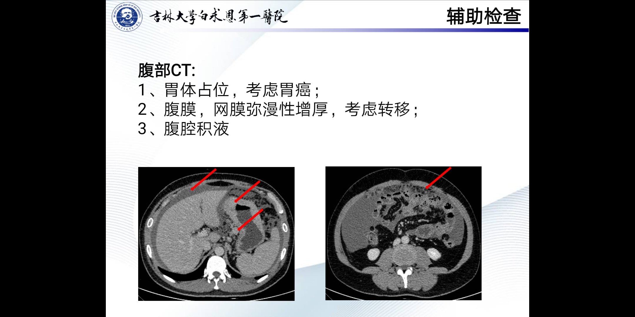 胃癌发生腹膜转移还能不能治了 - 好大夫在线
