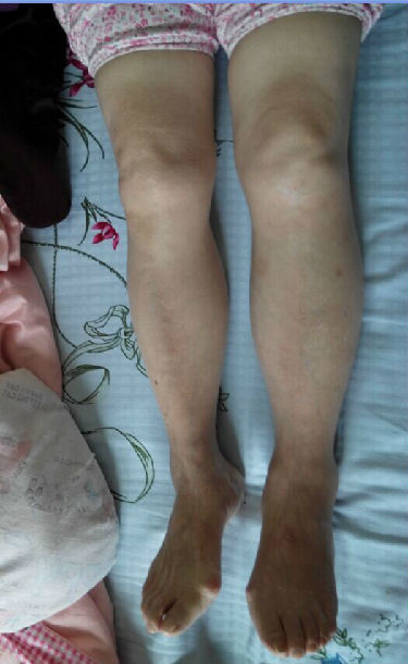 者术后提问及张华医生回答精选,持续更新中.