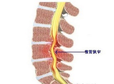 腰椎管狹窄是由於腰椎退行性改變,因椎間盤突出,韌帶肥厚,骨質增生而