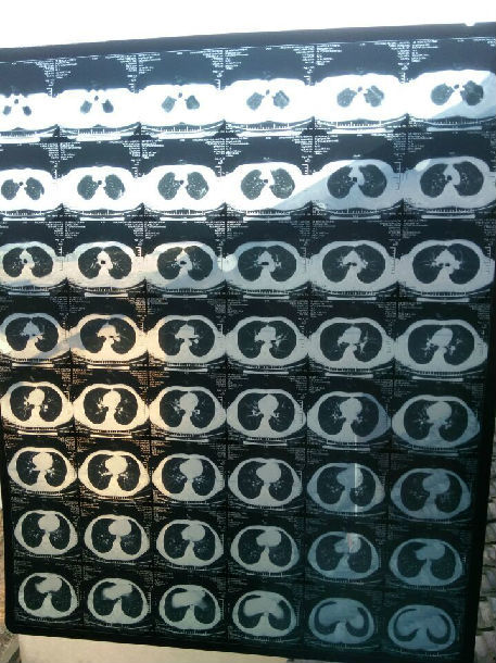 请上传清晰的ct照片