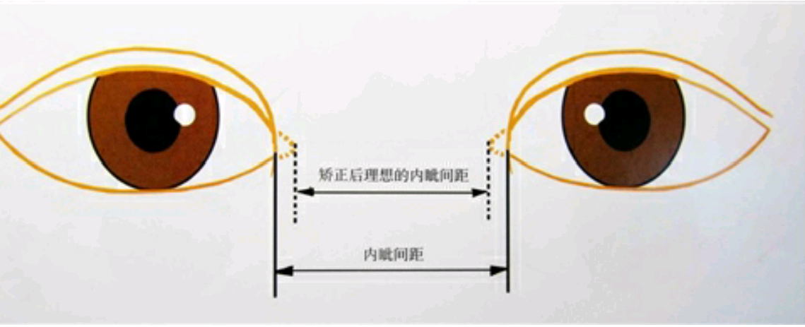 为什么要做开眼角手术(内眦开大)手术?-有来医生