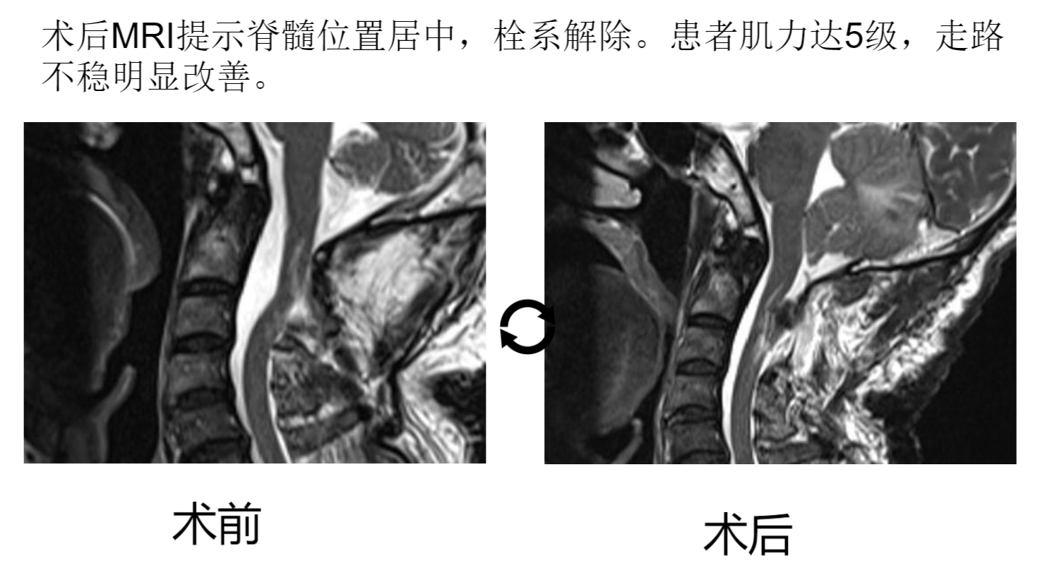 硬脊膜膨出的照片图片